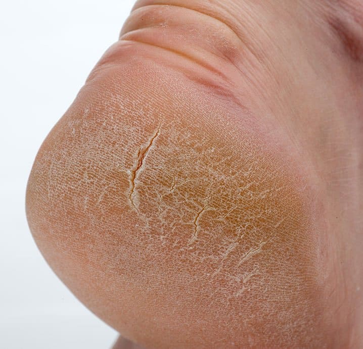 Dry Skin On Heels: Cracked &  Rough Treatment Options