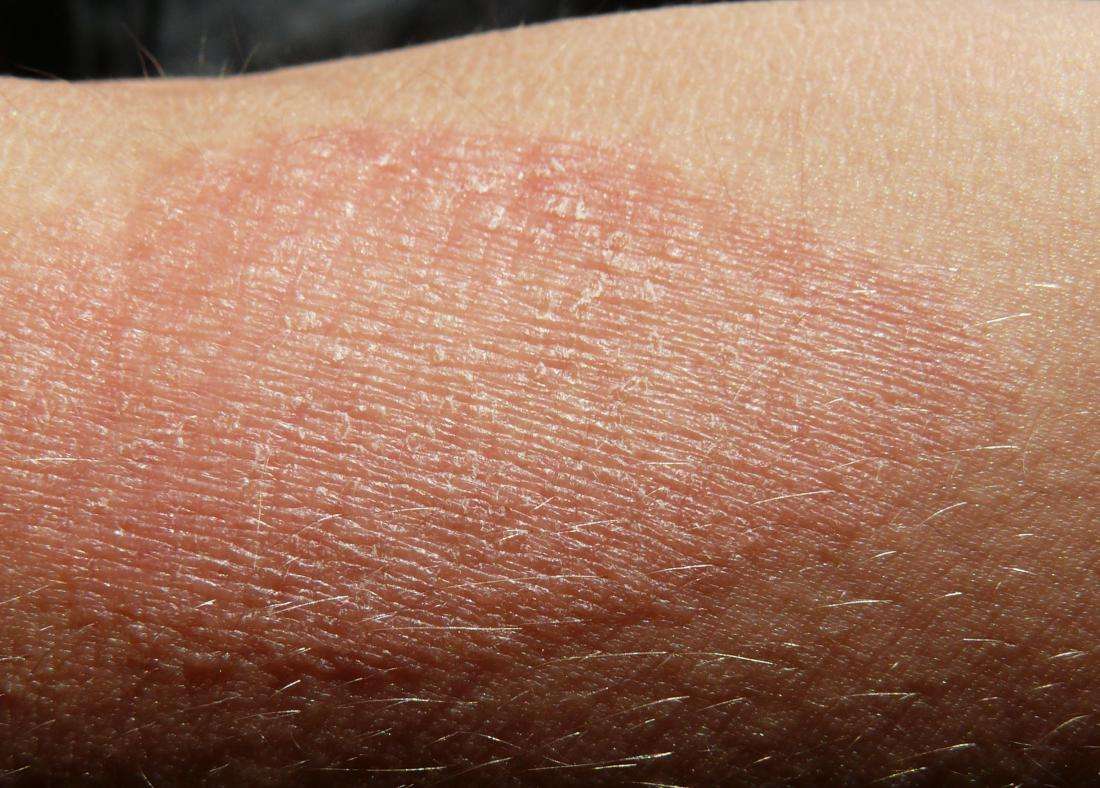 Dry skin patches: Causes, symptoms, diagnosis, and treatments