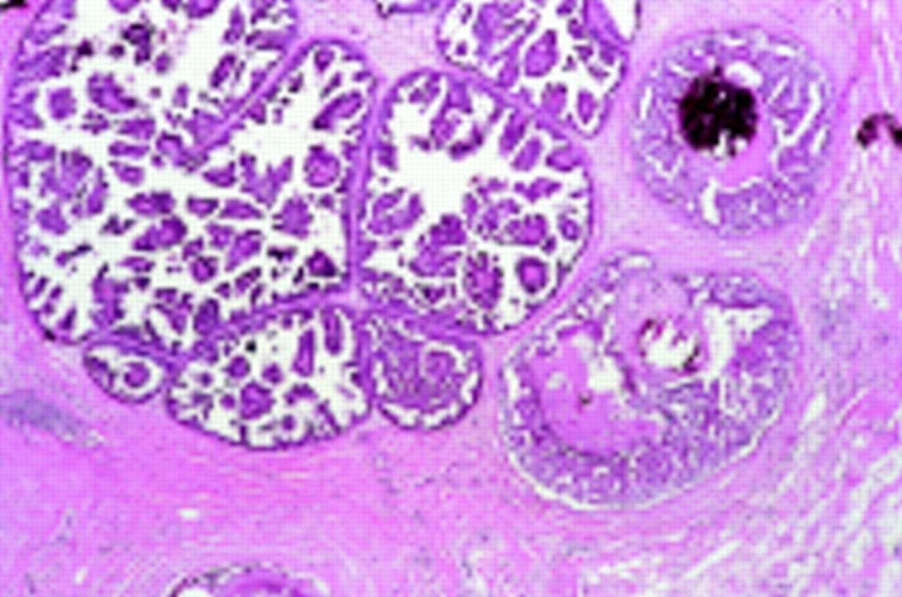 Ductal carcinoma in situ of the breast