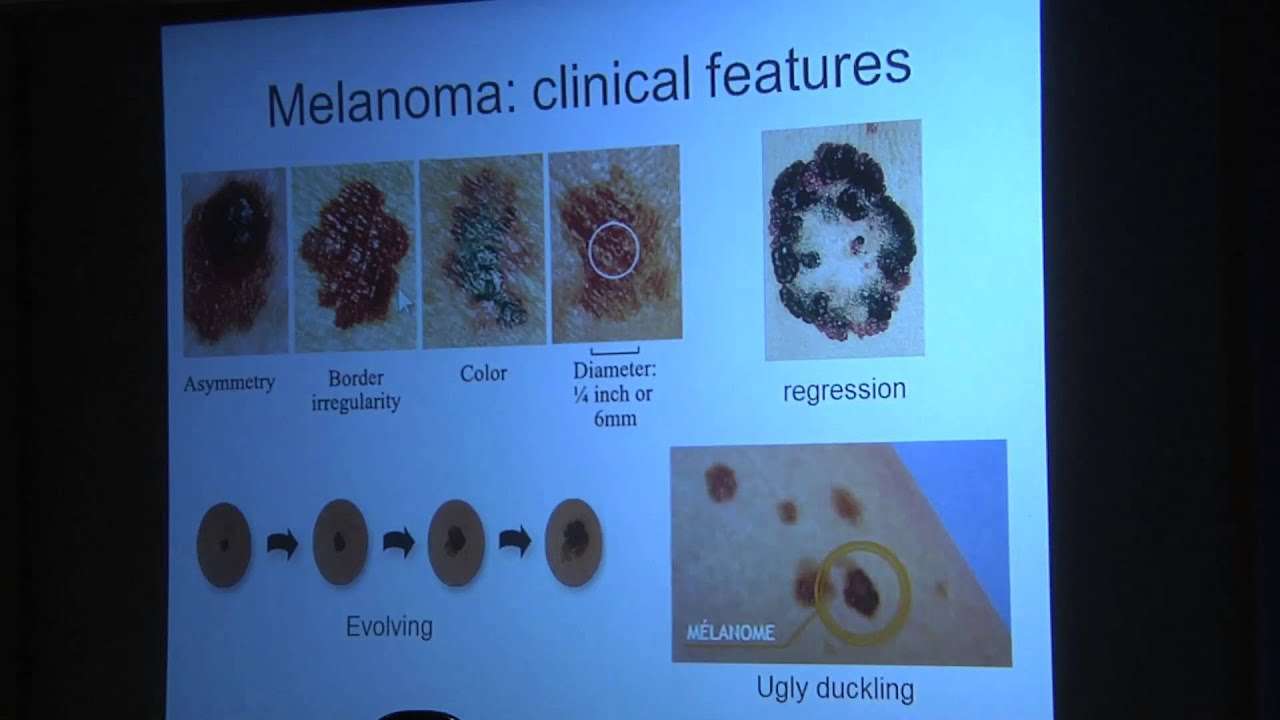 Early Detection of Melanoma