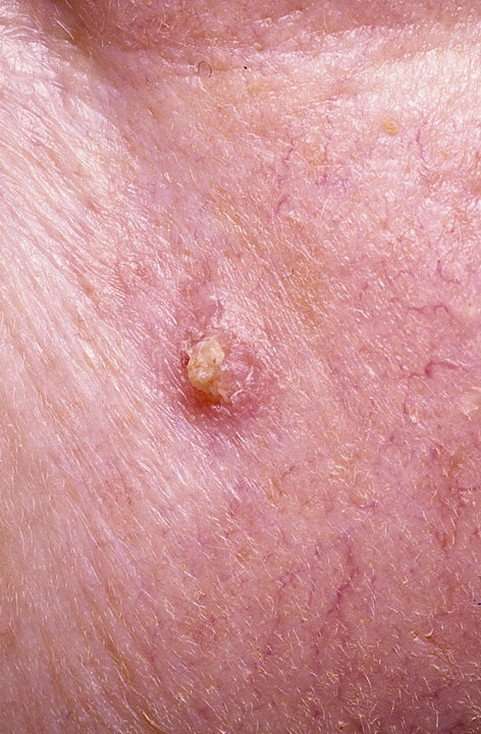 Early Signs of Skin Cancer Pictures â 15 Photos &  Images ...