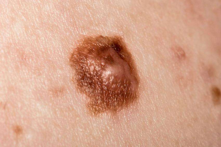 Early Skin Cancer Pictures