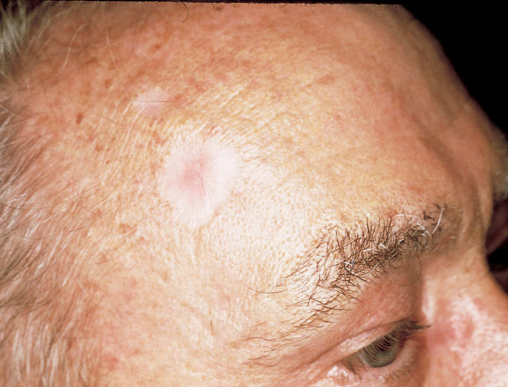Early Stage Skin Cancer On Face Symptoms