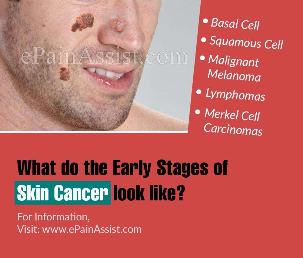 Early Stage Skin Cancer Signs And Symptoms