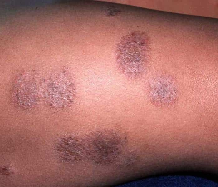 eczema: Eczema On Face Black People