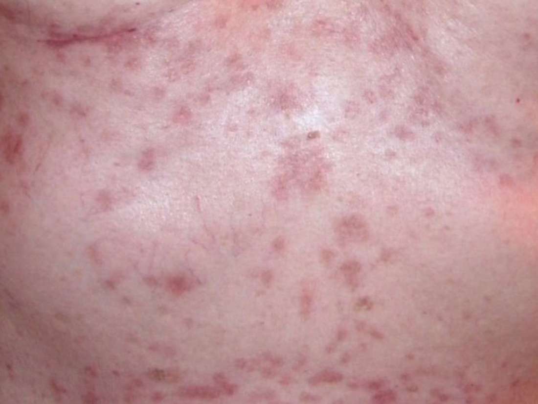 Eczema may reduce skin cancer risk, study suggests