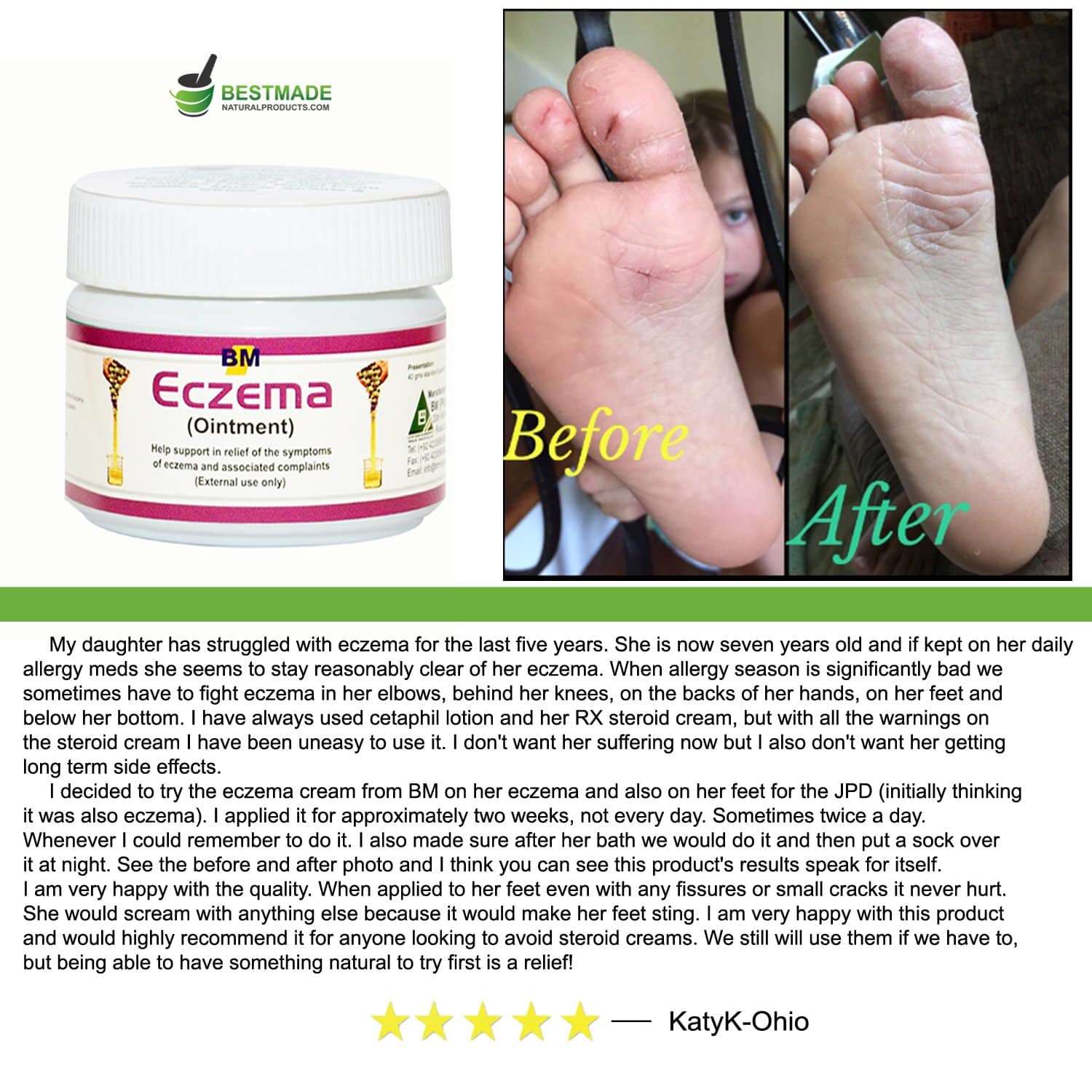 Eczema Ointment, 40gm, a Natural Treatment for Eczema, Psoriasis and ...