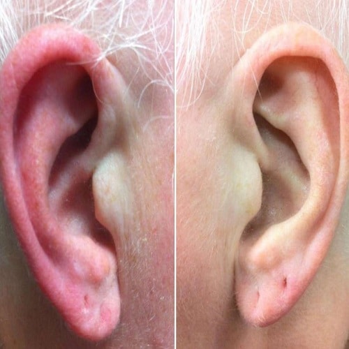 Eczema on Ear