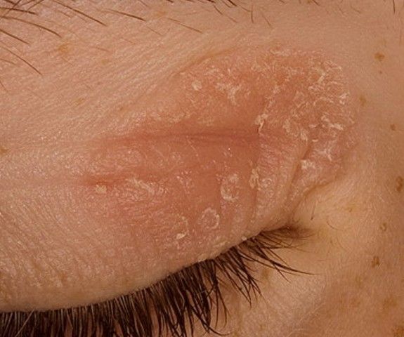 Eczema on eyelids