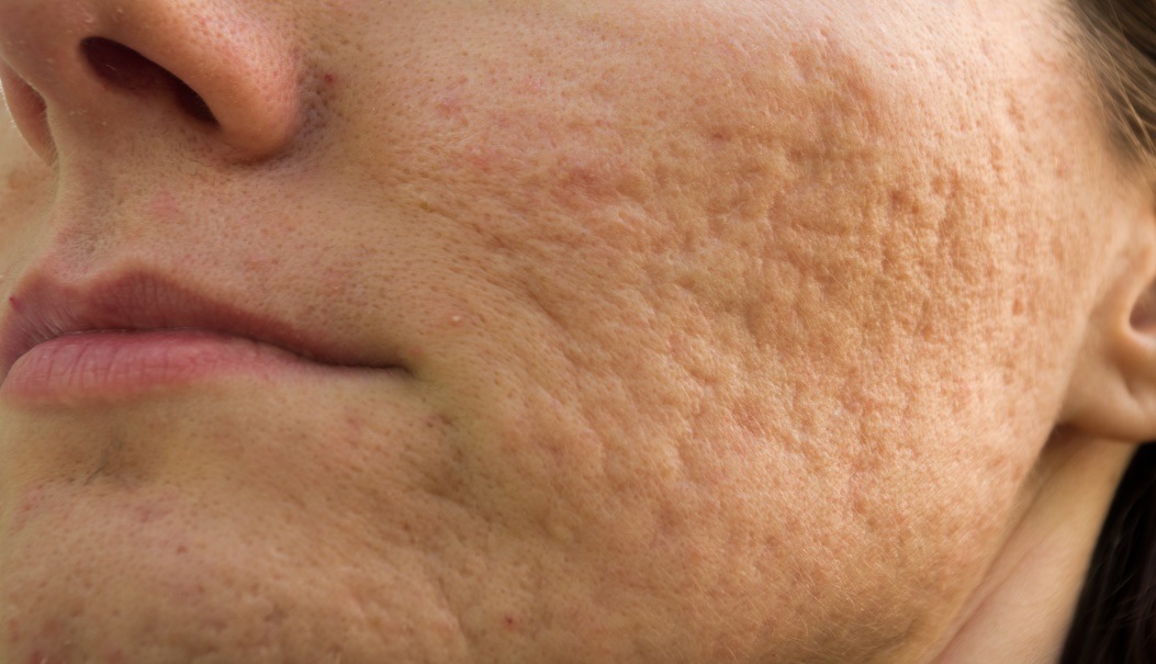 Enlarged Pores  Swiss Clinic