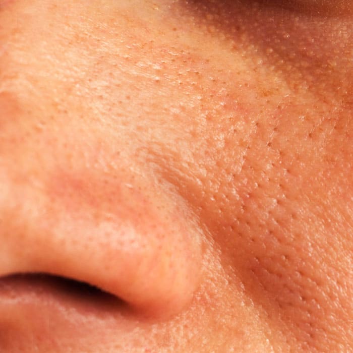Enlarged Pores Treatment in East Sussex