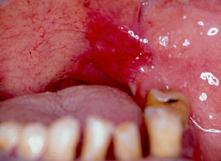 Erythroplastic oral squamous cell carcinoma.