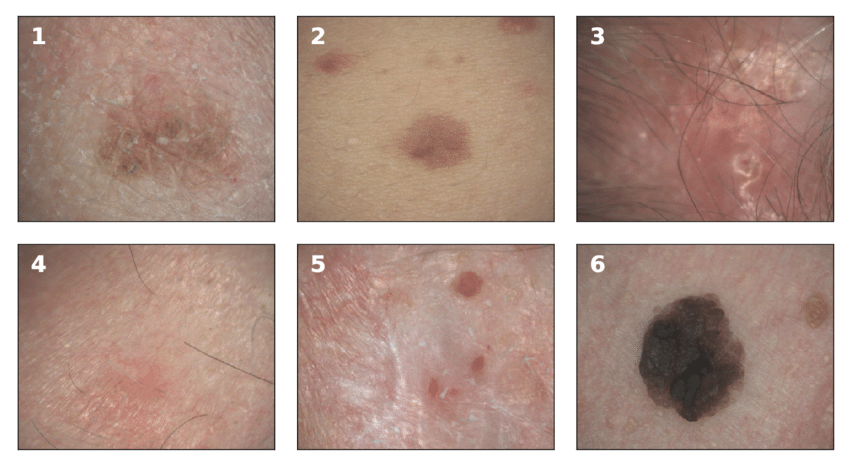 Examples of melanoma and non
