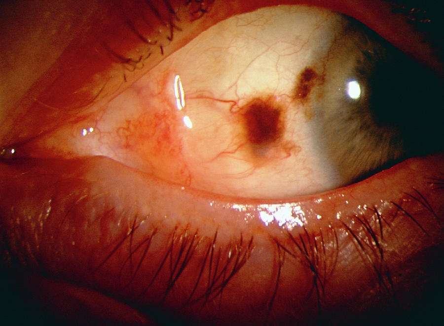 Eye Cancer Photograph by Sue Ford/science Photo Library