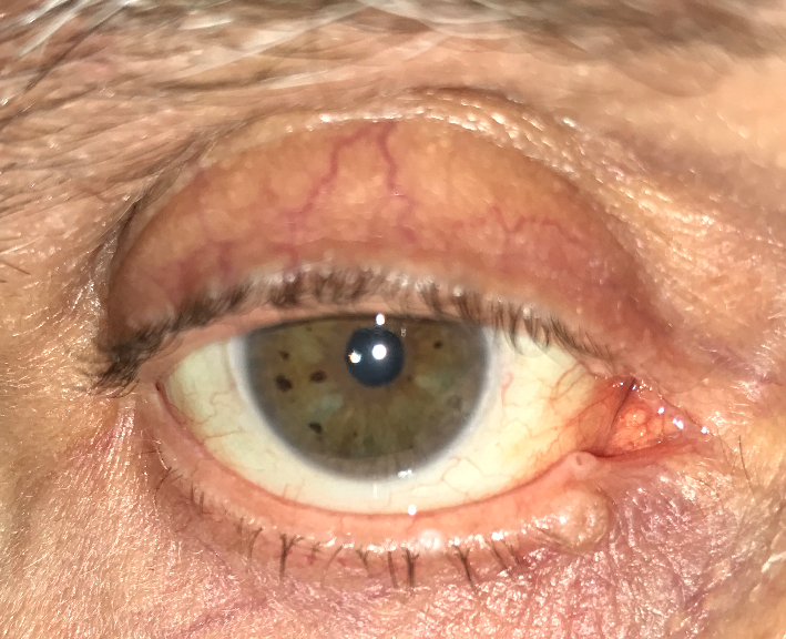 Eyelid Cancer...what does it look like?