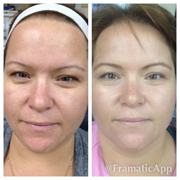 Face Laser Treatment Side Effects