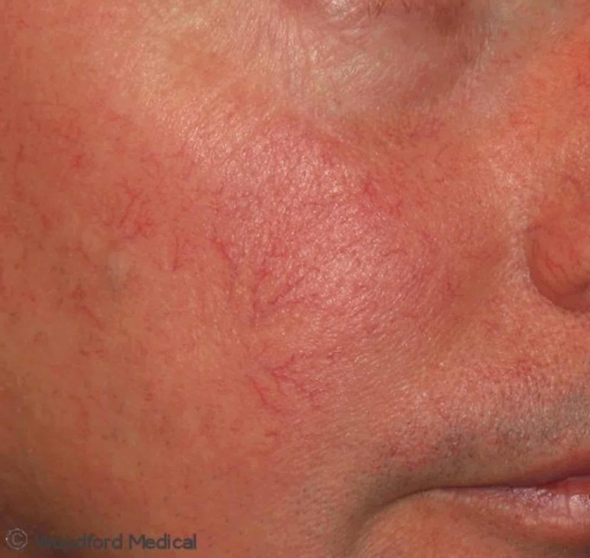 Facial Redness, Rosacea And Blushing