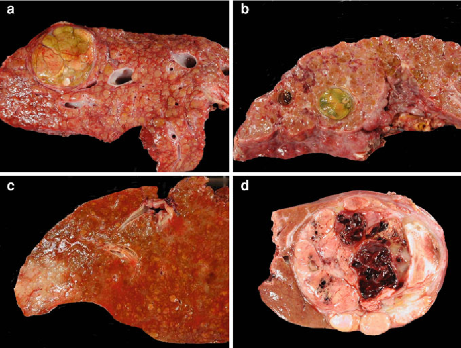 Figure 1 from Histopathology of hepatocellular carcinoma ...