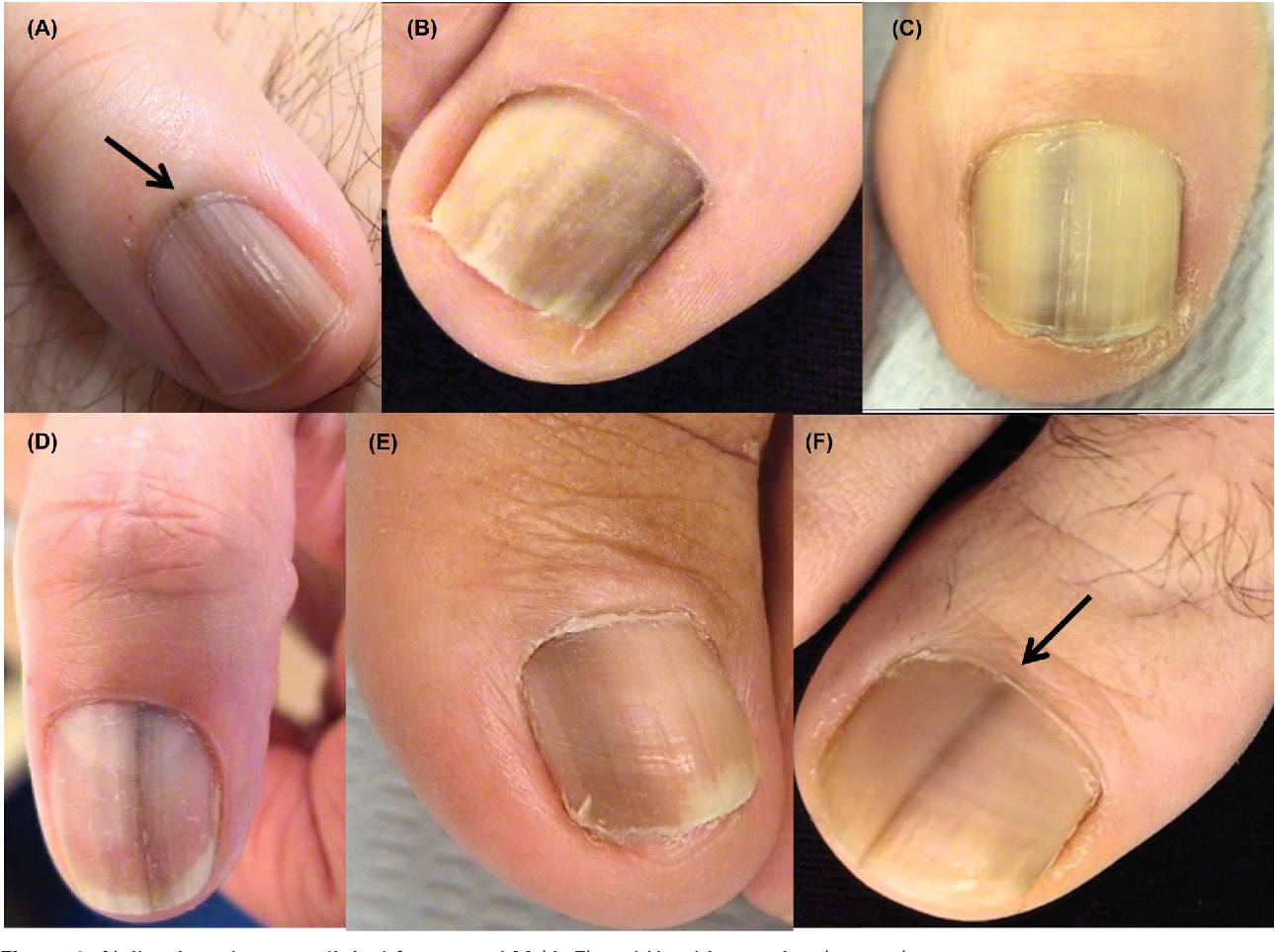 Figure 1 From Nail Melanoma In Situ Clinical Dermoscopic Pathologic 