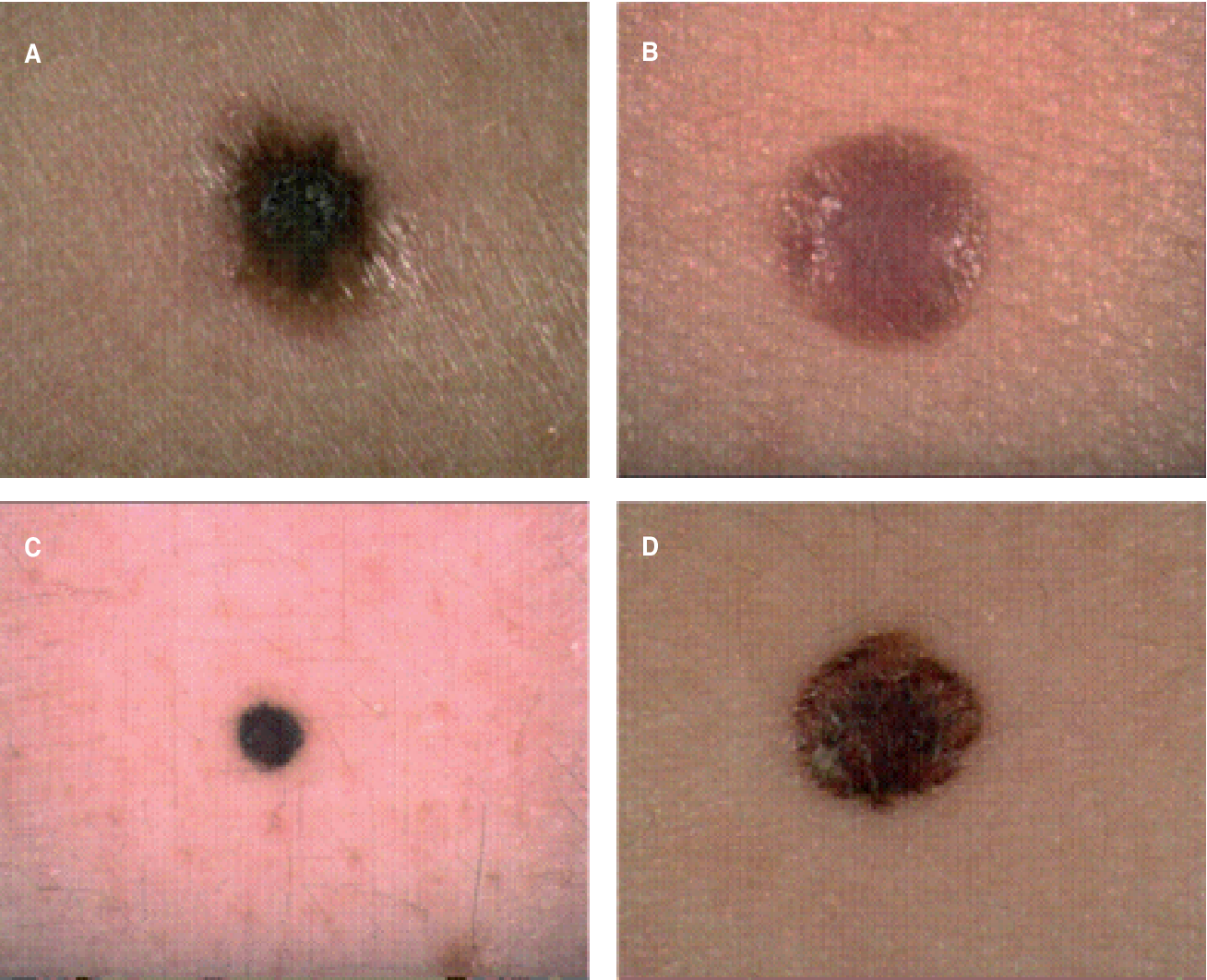 Figure 1 from Small Nodular Melanoma: The Beginning of a ...