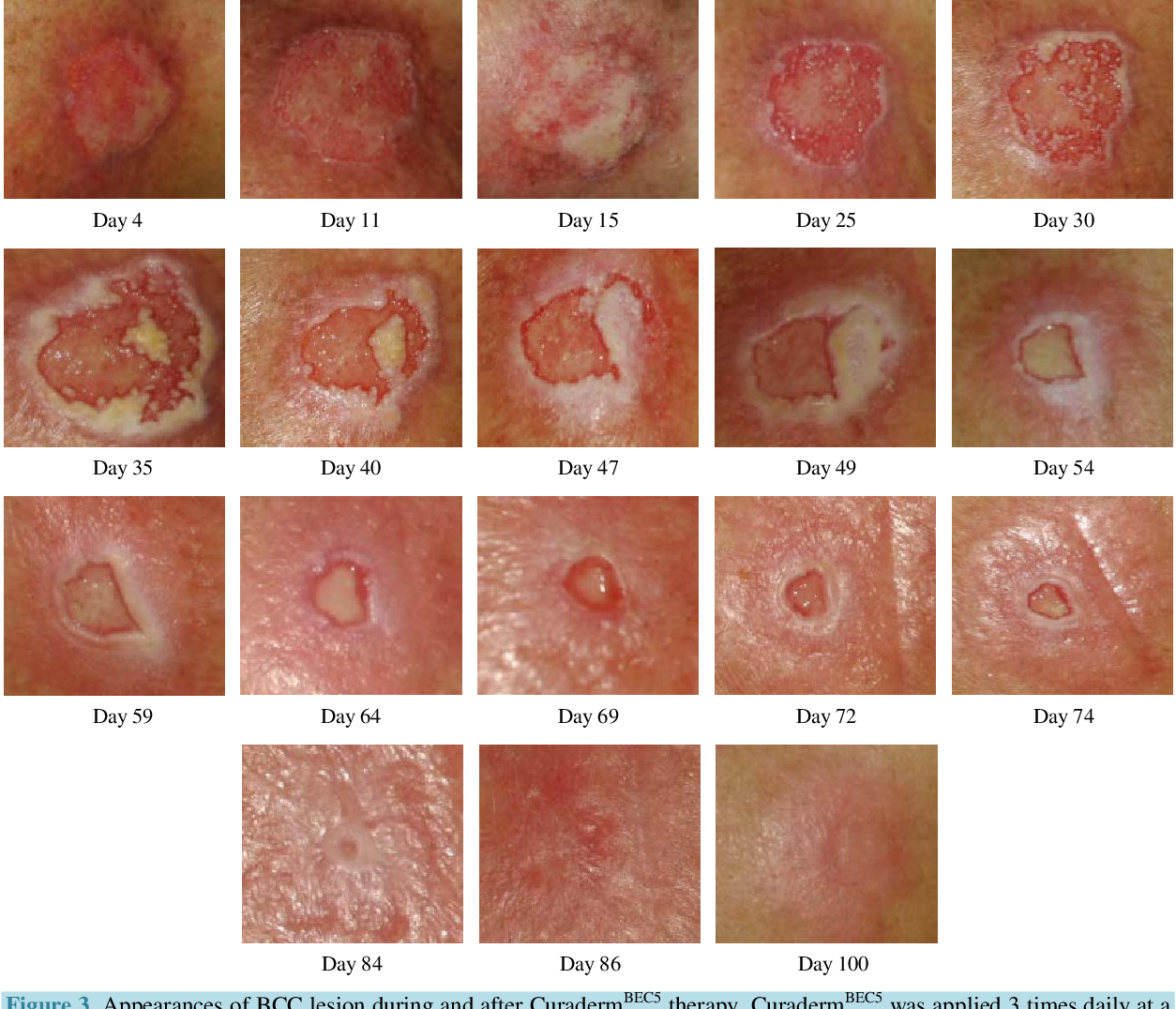 Figure 2 from Treatment of Skin Cancer with a Selective ...