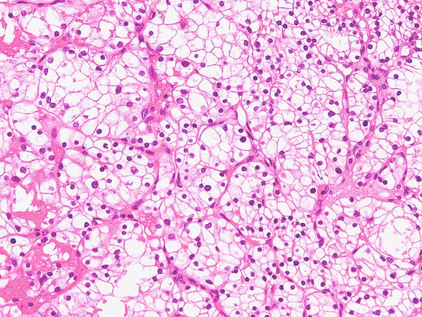 Figure4. Clear cell renal cell carcinoma, showing a ...