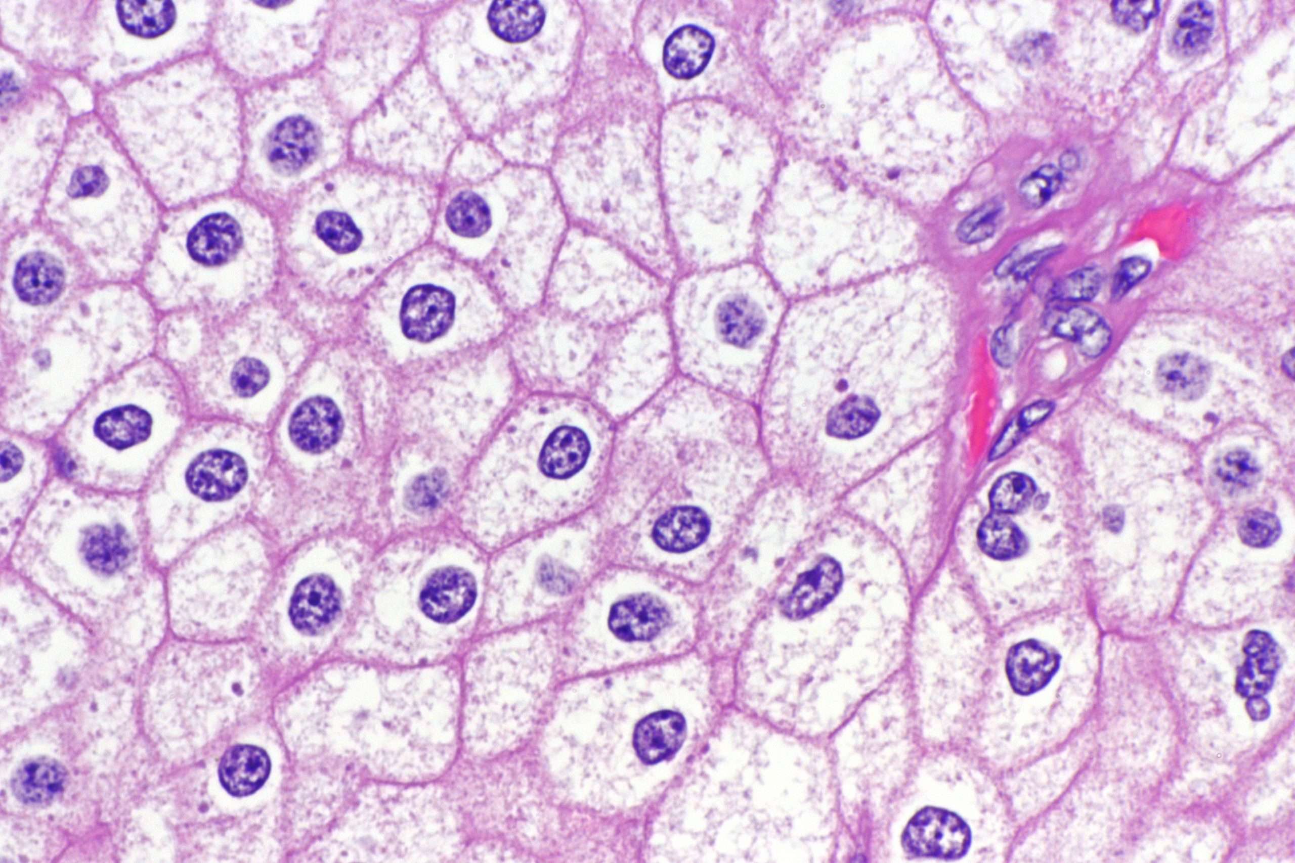 File:Chromophobe renal cell carcinoma