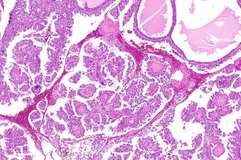 File:Hereditary leiomyomatosis and renal cell carcinoma ...