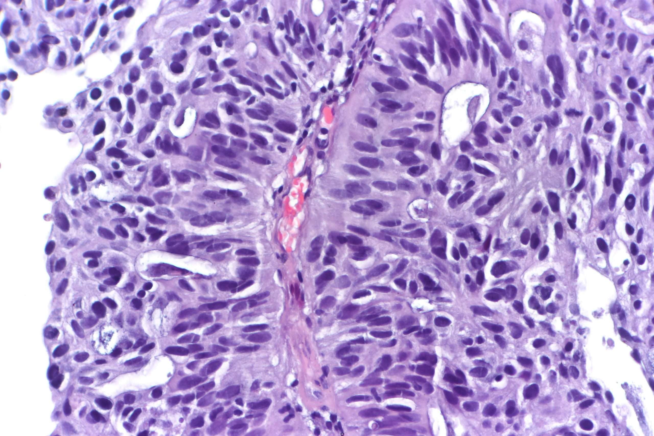 File:Papillary urothelial carcinoma with glandular ...