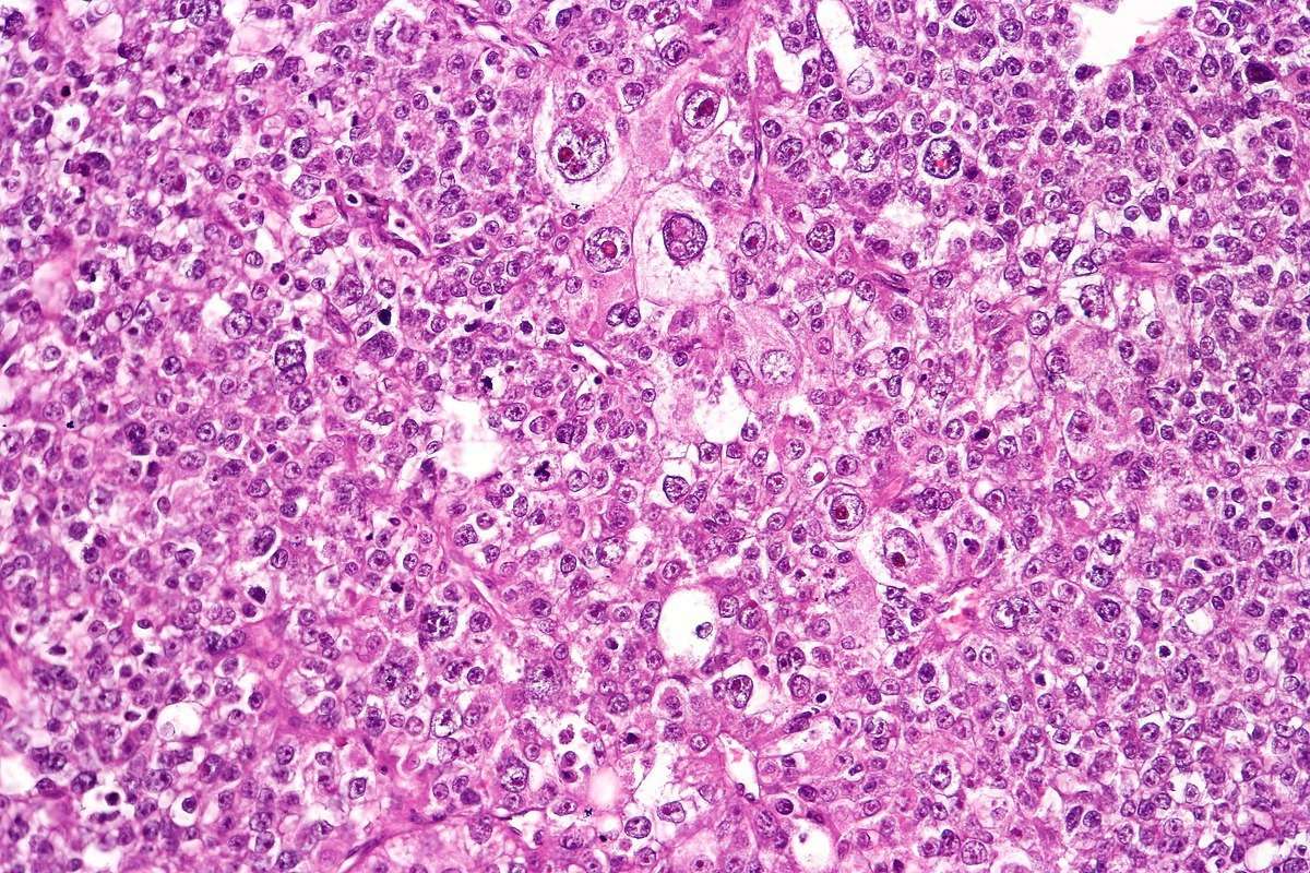 File:Poorly differentiated gastric adenocarcinoma, high ...