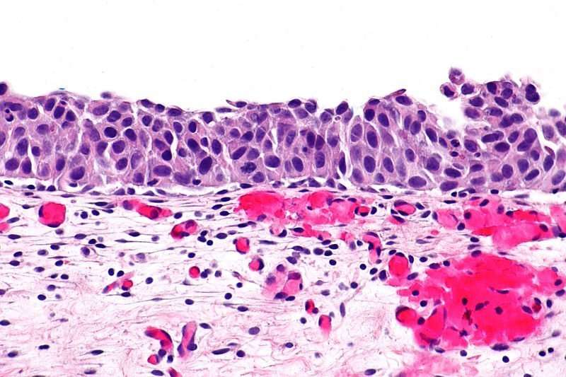 File:Urothelial carcinoma in situ
