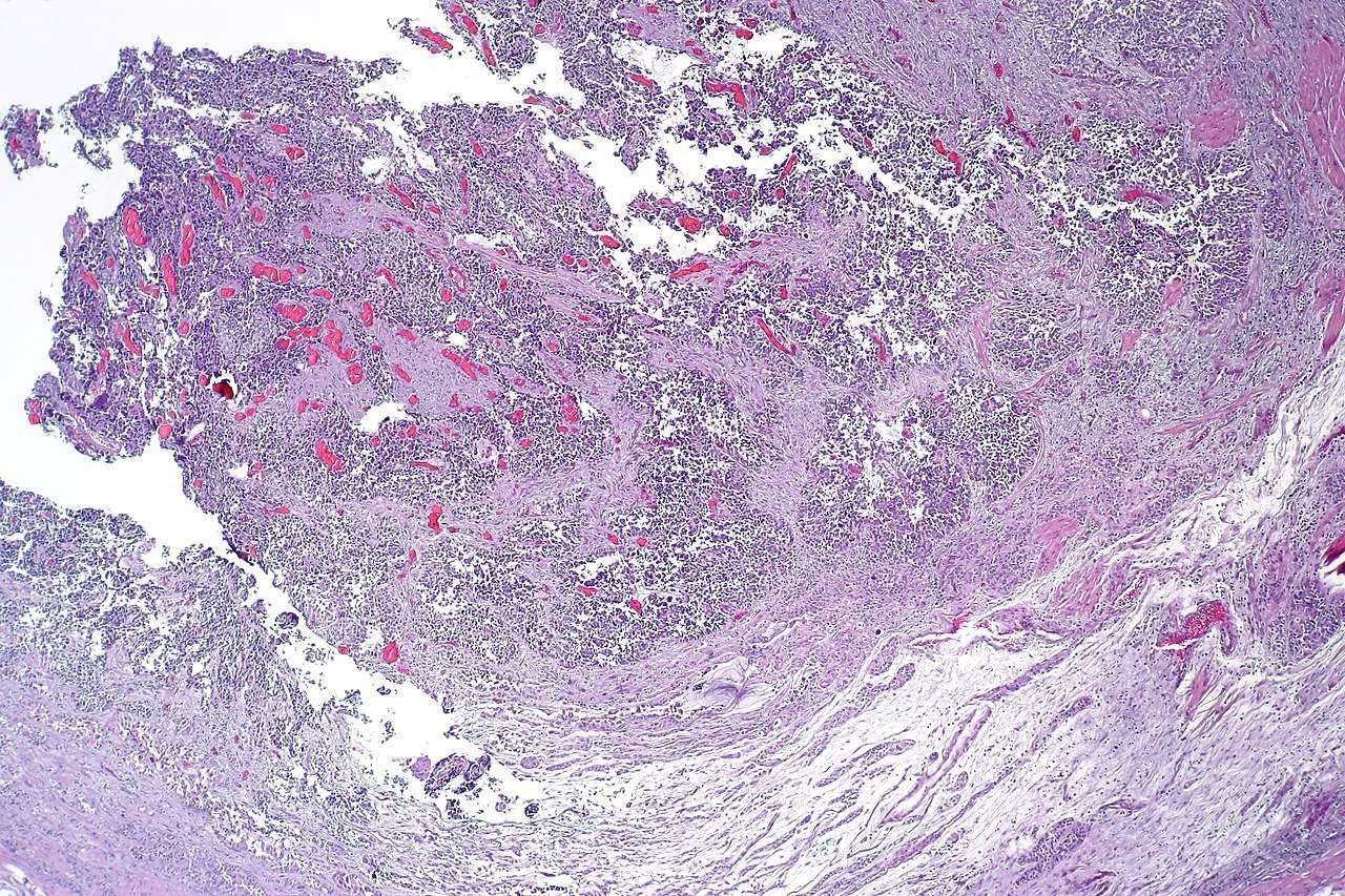File:Urothelial carcinoma of the ureter, low mag.jpg ...