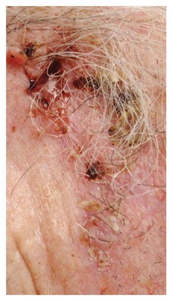 Focus on Basal Cell Carcinoma