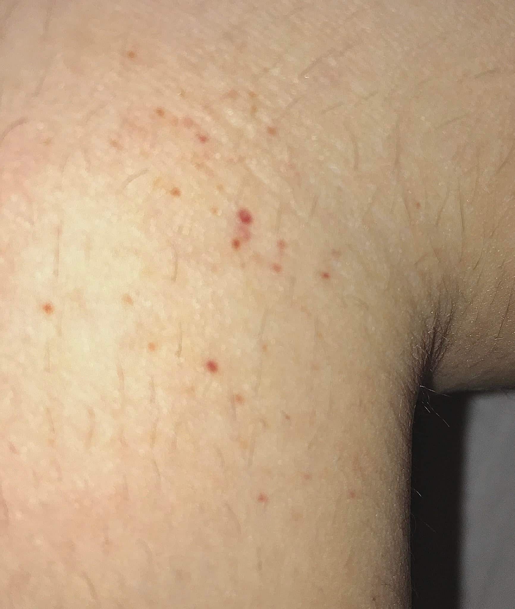 Found this little red dots all over my legs and feet, they are plain ...