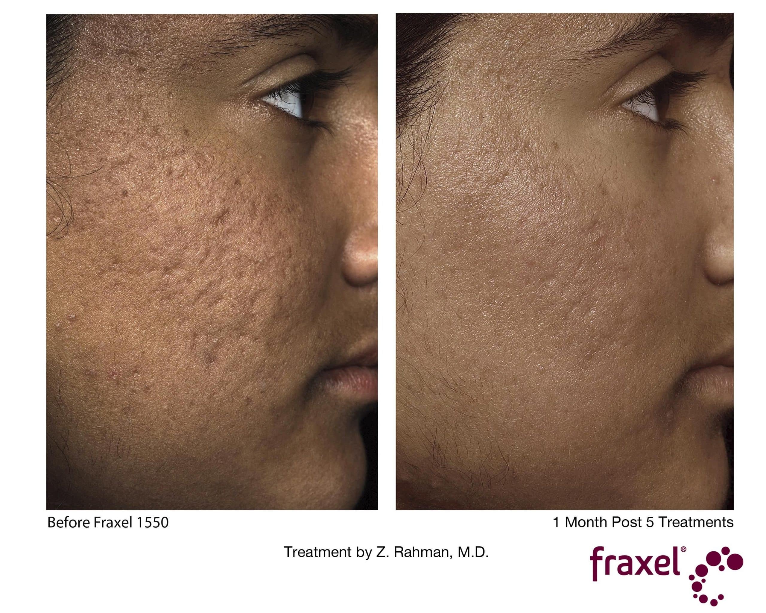Fraxel Laser Before And After Dark Skin