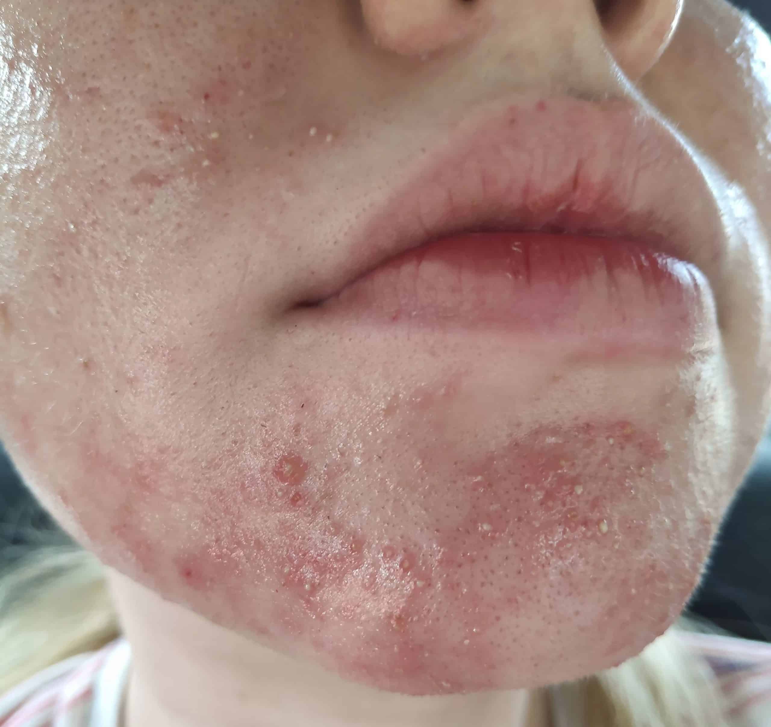 From Fungal Acne/Folliculitis to Clear Skin (with Pictures)