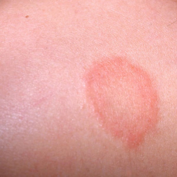 Fungal Infection of the Skin (Ringworm)