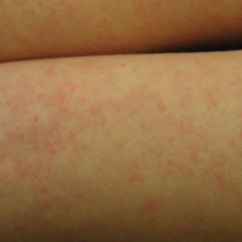 Gallery of Hives Pictures for Identifying Rashes