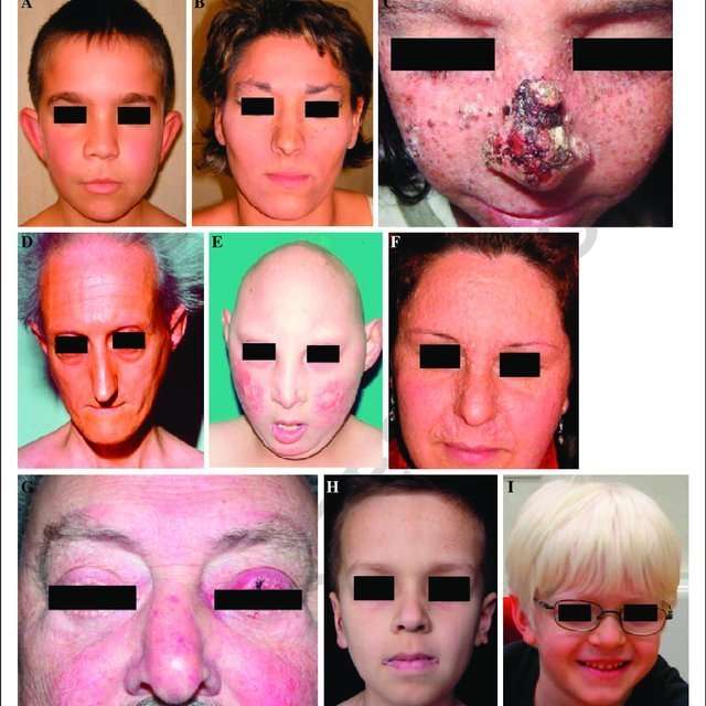 Genetic syndromes with basal cell carcinoma as a prominent ...