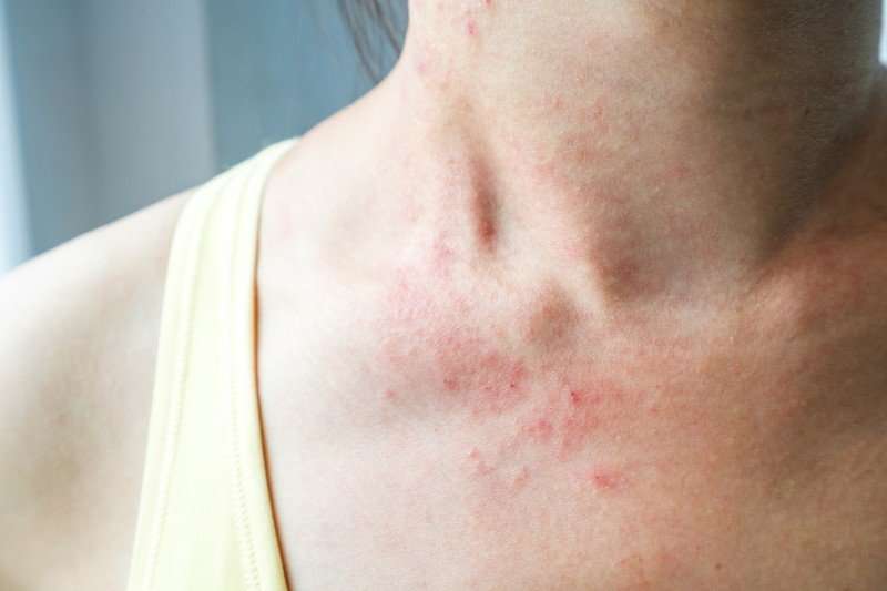 Get Rid of Ringworm Overnight With These 5 Home Remedies ...