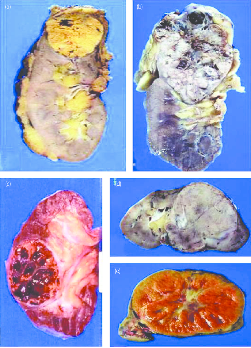 Gross features of main epithelial tumors of the kidney ...