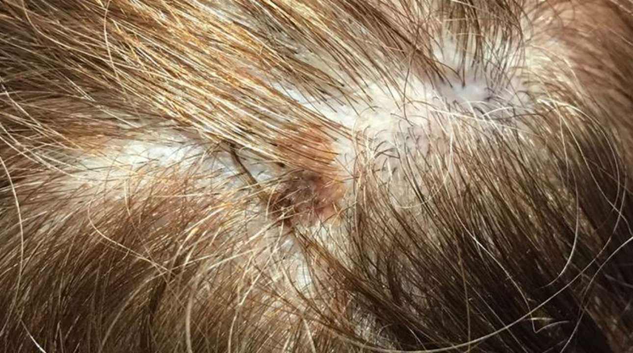 Hairstylist Spotted Cancer on Scalp