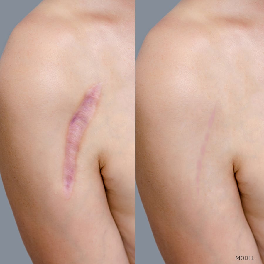 Hate Your Scar? Revision is possible