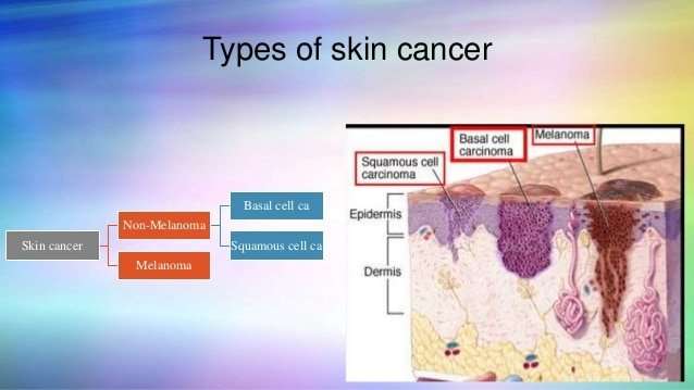 head and neck skin cancer