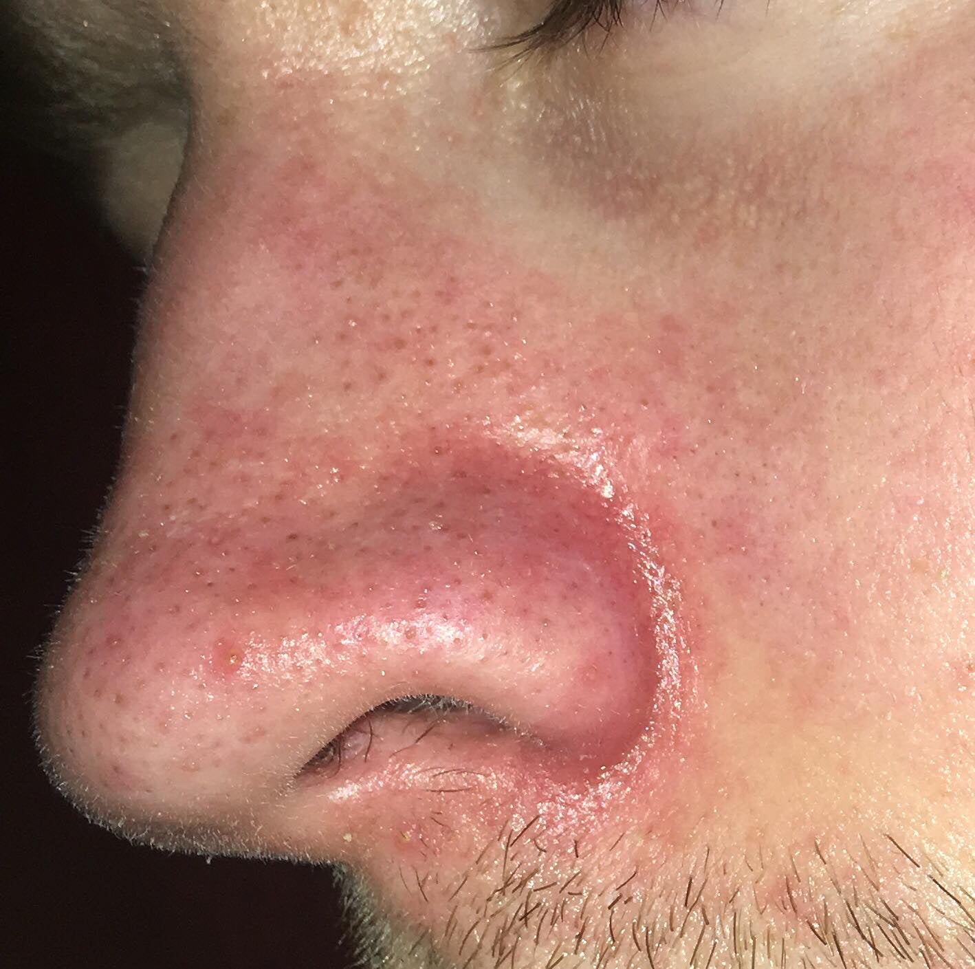 Help my red, oily, flaky nose [Skin concerns] : SkincareAddiction
