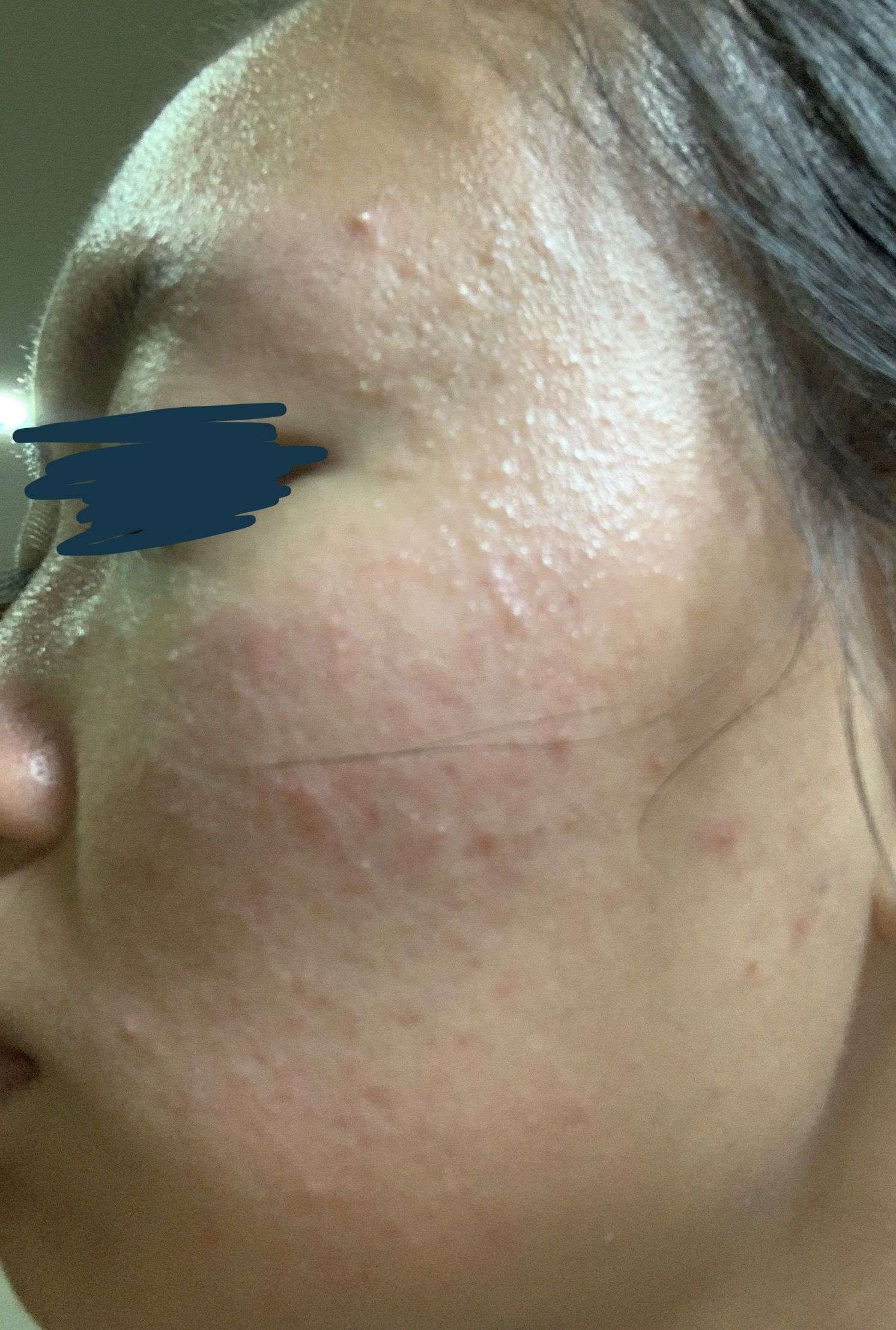 help! what type of acne is this and what can i do about it ...