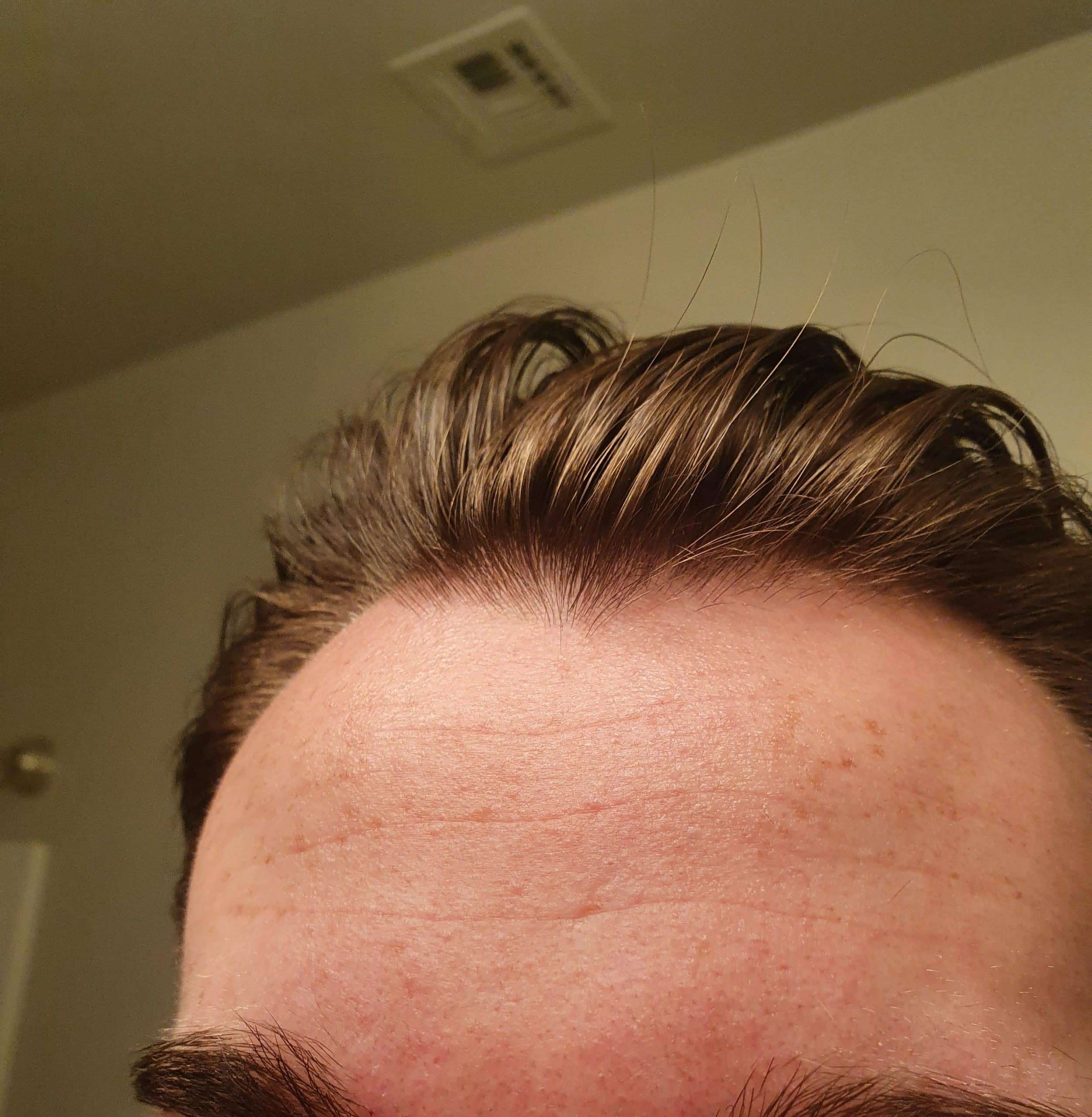 Help with getting rid of textured and bumpy skin? Anything that can ...