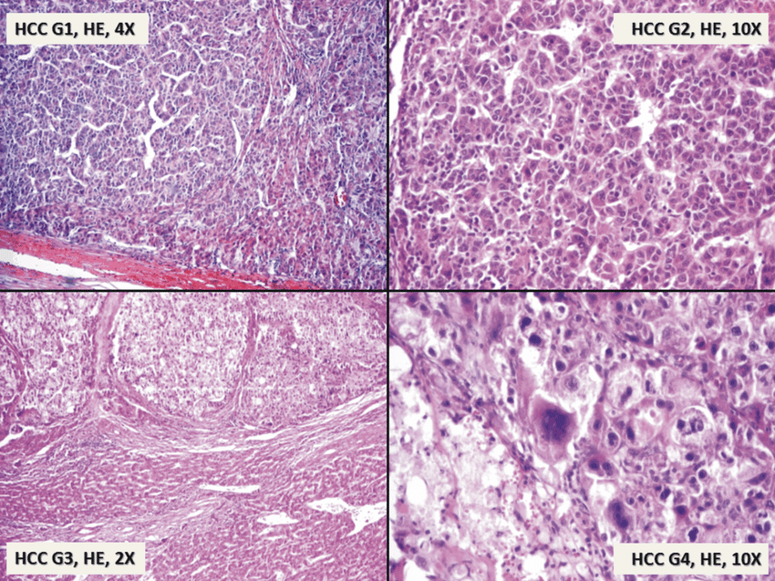 Hepatocellular carcinoma (HCC): histologic grade ...