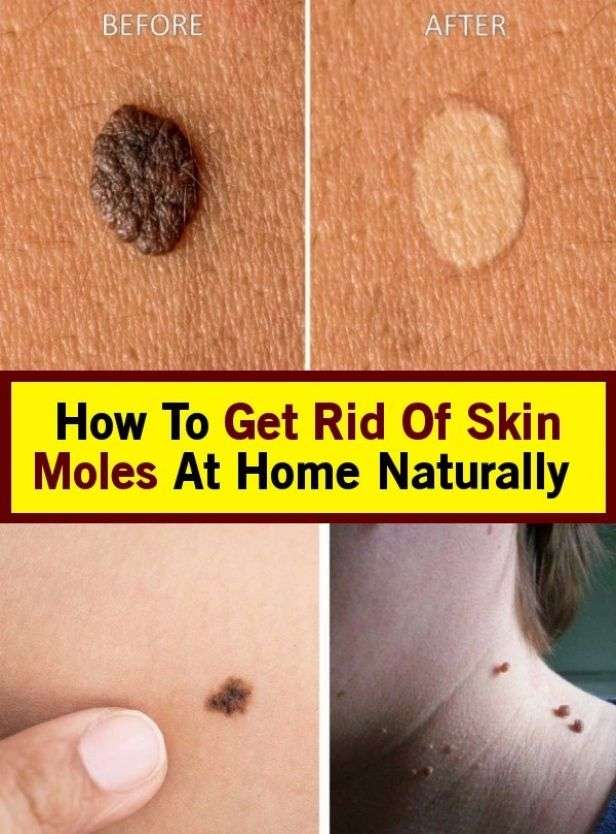 Here naturally how to get rid of skin moles.