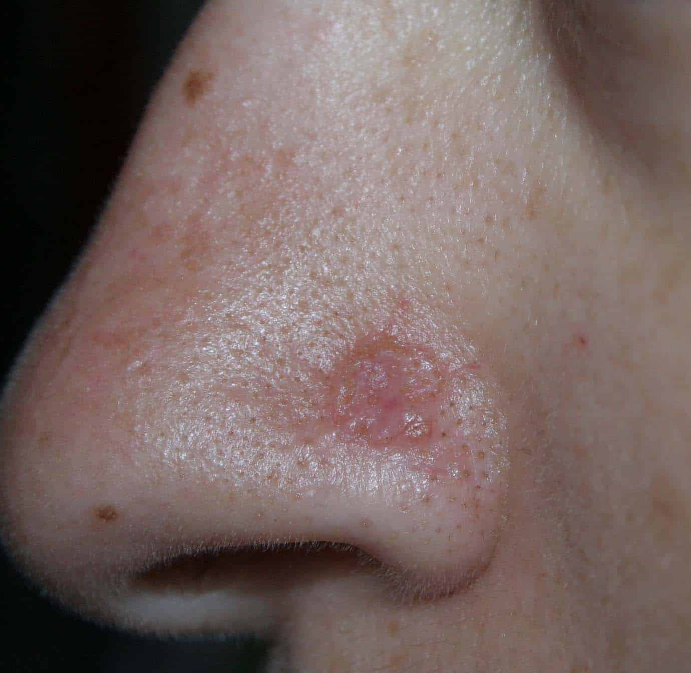 Hi, I got this sore on my nose about 8 years ago, perfectly